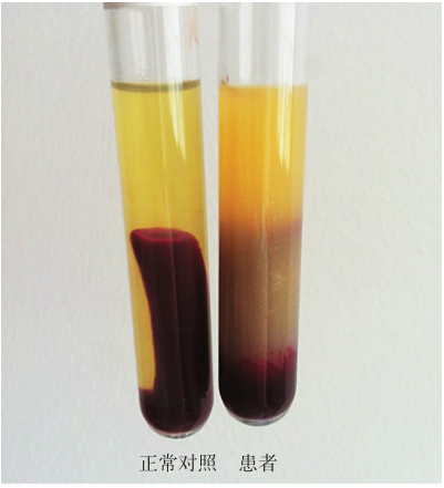 图1 冷球蛋白试验阳性